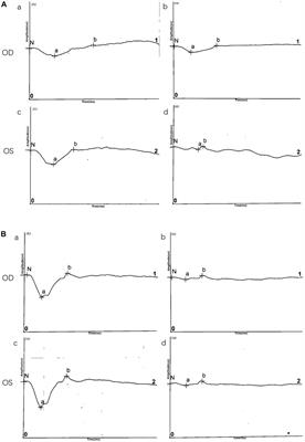 A novel mutation in RS1 and clinical manifestations in a Chinese twin family with congenital retinoschisis